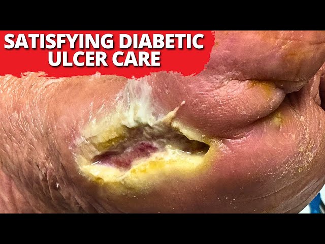 Ultimate Wound Care: Diabetic Ulcer Grafting Transformation!