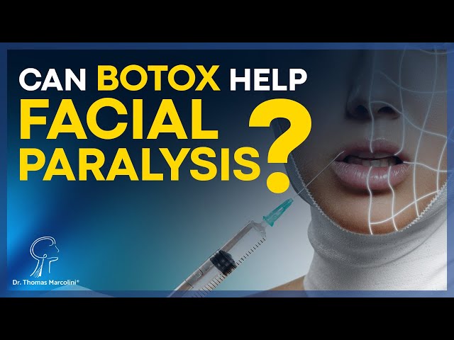 Botox for Facial Paralysis: Everything You Need to Know!