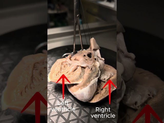 #ASD #heart #cardiac #anatomy #morphology #physiology #science #education #medicine #shorts #chd