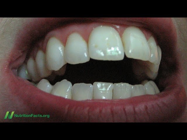 Oil Pulling for Teeth Whitening and Bad Breath Tested