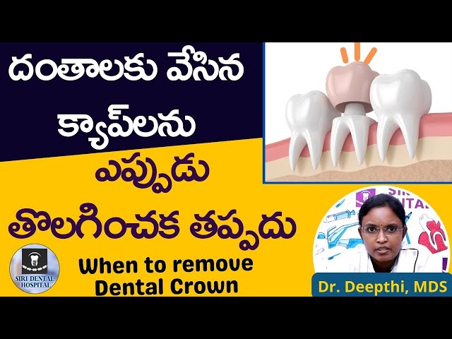 డెంటల్‌ క్యాప్‌లను ఎప్పుడు తీయక తప్పదు | When To Remove Dental Crowns | Tooth Cap |  Siri Dental