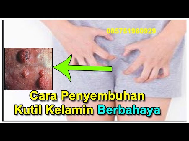 Cara Penyembuhan Kutil Kelamin Yang Berbahaya