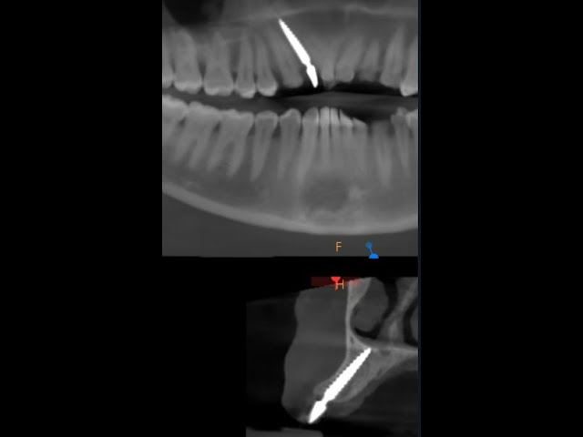 Missing upper lateral incisors replacement with bioline  3.75*20mm implant- best laser dental