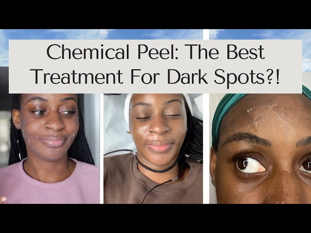 HOW I GOT RID OF MY ACNE SCARS! TCA Chemical Peel | Procedure + Before and After