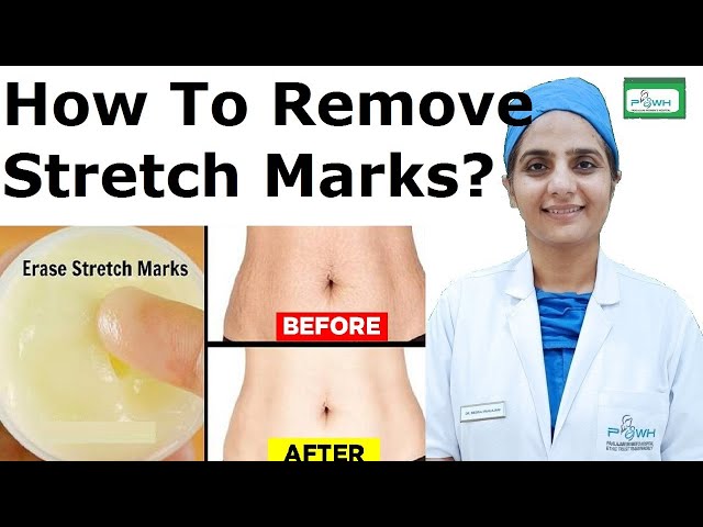 How To Remove Stretch Marks Permanently | स्ट्रेच मार्क्स जल्दी कैसे हटाए?