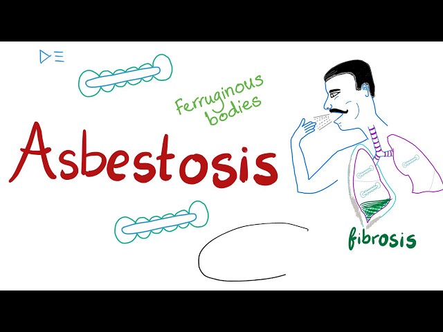 Asbestosis - Mesothelioma - Occupational Lung Disease - Restrictive Lung Disease - Pulmonology