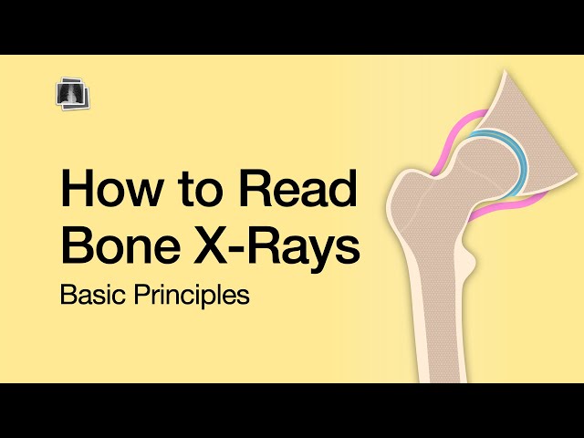 How to Read Bone X-Rays