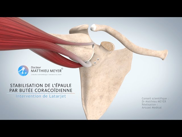 STABILISATION DE L'ÉPAULE PAR BUTÉE CORACOÏDIENNE (INTERVENTION DE LATARJET) - DR MATTHIEU MEYER