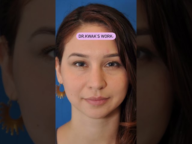 Plastic Surgery Natural Results | Rhinoplasty Results | Nose Job Results