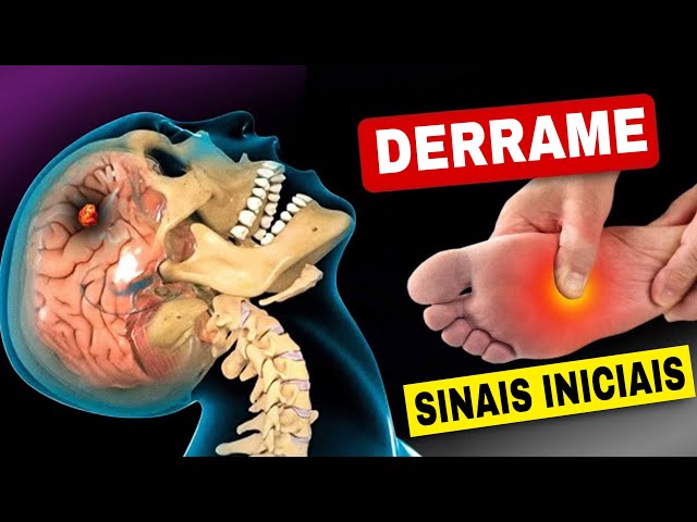 8 Sinais de Alerta de DERRAME CEREBRAL (AVC) Um Mês Antes + 9 Dicas Poderosas para Evitar