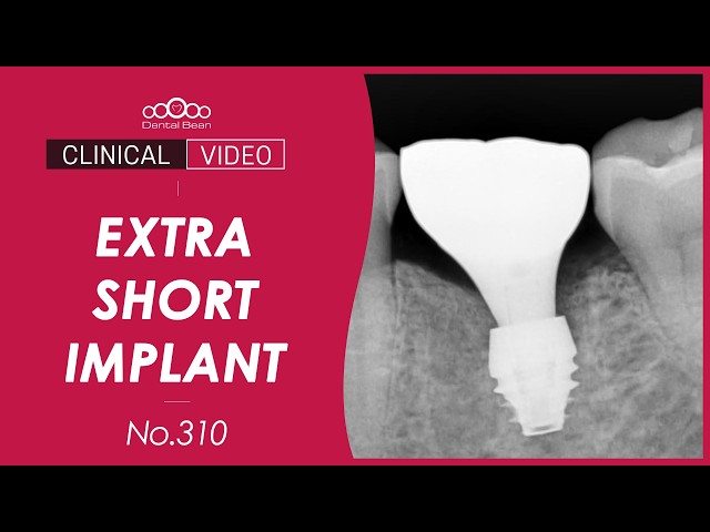 #36 Implant placement with CTG ; Roll Technique [Dr. Cho Yongseok]