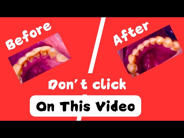 Tartar On Teeth Removal & Plaque(Stain) Removal