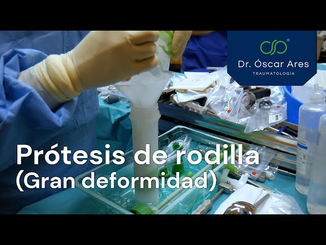 Artrosis con gran deformidad (Prótesis de rodilla) - Dr. Oscar Ares