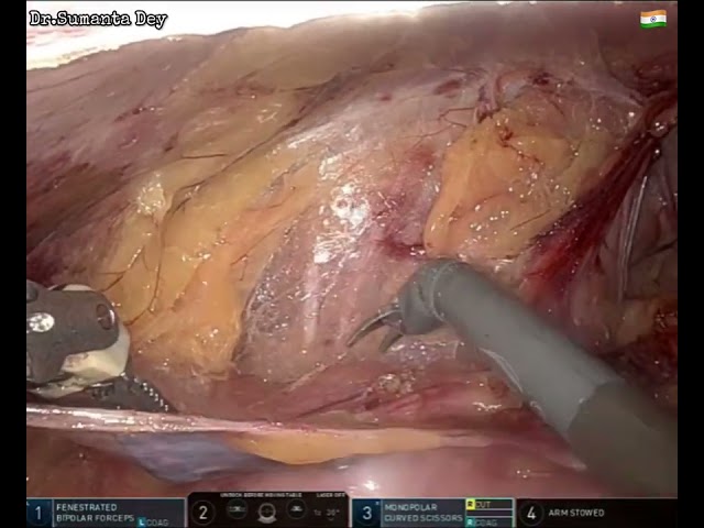 Robotic Inguinal Hernia repair: rTAPP (Uncut with Voiceover) by Dr.Sumanta Dey