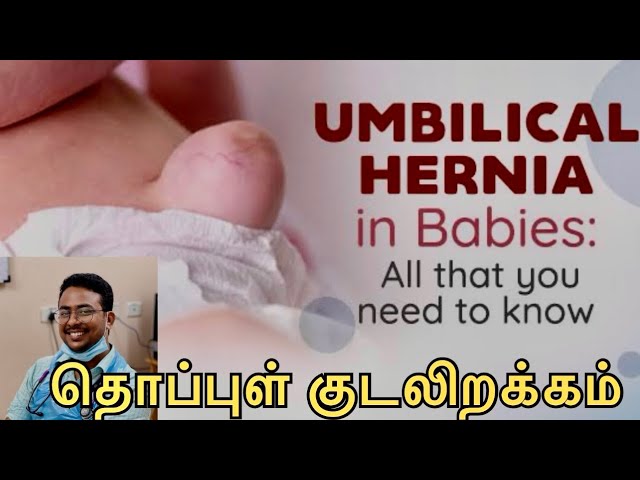 Umbilical hernia #hernia