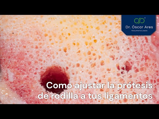 COMO AJUSTAR LA #PRÓTESIS DE #RODILLA A TUS LIGAMENTOS- ROBOT ROSA