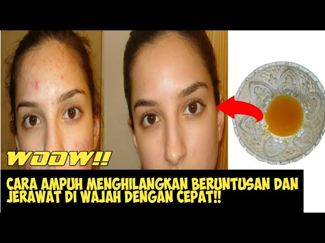 CARA MENGHILANGKAN BERUNTUSAN DAN MENGHILANGKAN JERAWAT MEMBANDEL DI BAGIAN WAJAH!!)