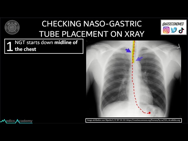 55 SECONDS on Checking NASOGASTRIC TUBE Placement on X-Ray