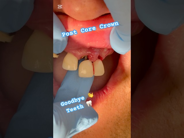 Bye Bye’s Bad Teeth , Post Core Crown failure