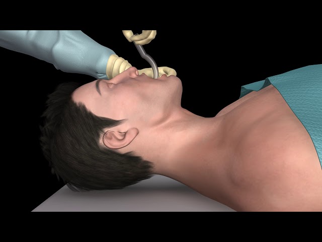 Oral airway insertion - oropharyngeal airway technique - 3D animation