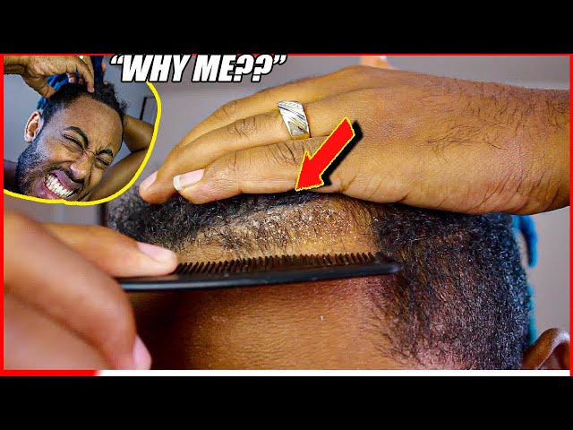 DISGUSTING DANDRUFF PROBLEM 🤢|💇🏿‍♂️