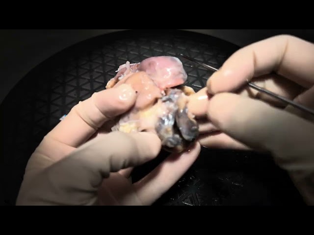 Specimen walkthrough 18- Pulmonary atresia intact ventricular septum