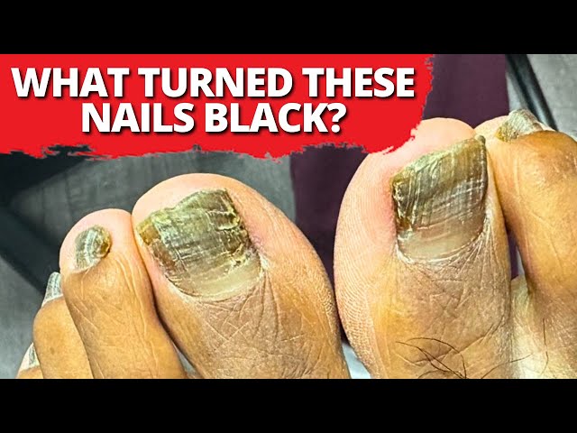 What Caused These Nails To Turn Black?! *Shocking Reveal*