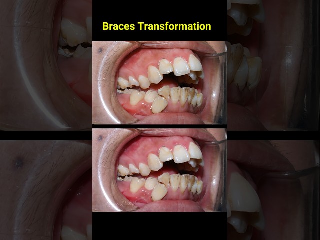 Braces Transformation 3 years #braces #dentist #orthodontist #niengrang #nhakhoa