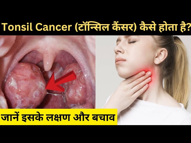 Tonsil Cancer Symptoms in Hindi | टॉन्सिल कैंसर कैसे होता है? | जानें इसके लक्षण और बचाव