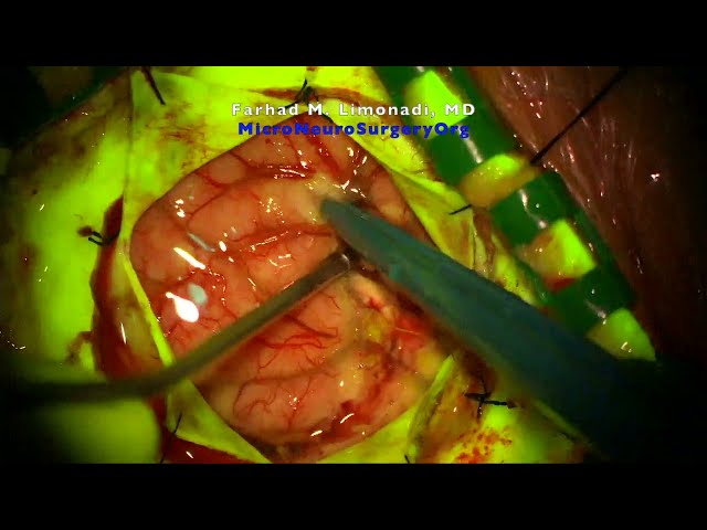 Parietal Craniotomy for Resection of Glioblastoma (GBM)