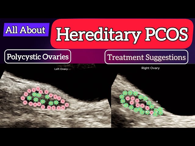 Hereditary PCOS - Treatment Suggestions | Ultrasound | Polycystic Ovaries