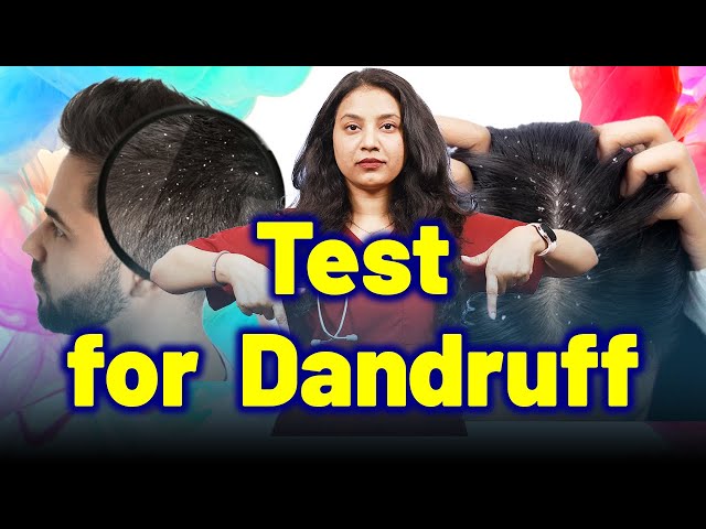 Test for Dandruff, Seborrheic Dermatitis, Psoriasis  | Treatment & Cure | Homeopathy, Medicine