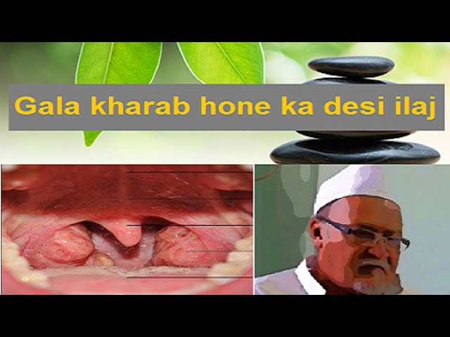 Hoarseness of Voice | Gala baithna  | Awaz baith na | Health Tips By Hakim Talha Sahab