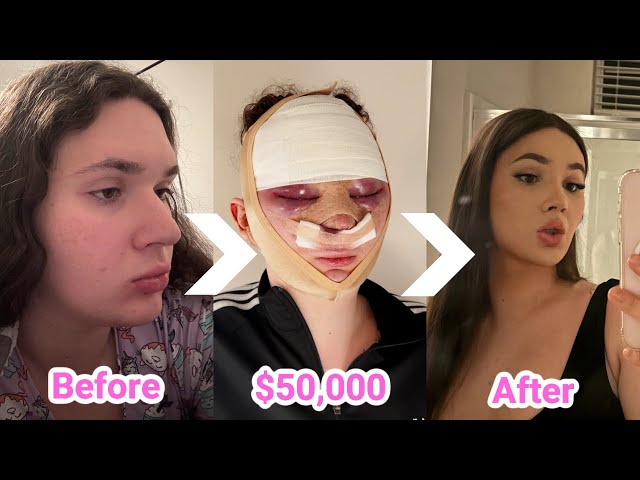 EXTREME $50,000 SURGERY GLOW UP IN KOREA | VLOG