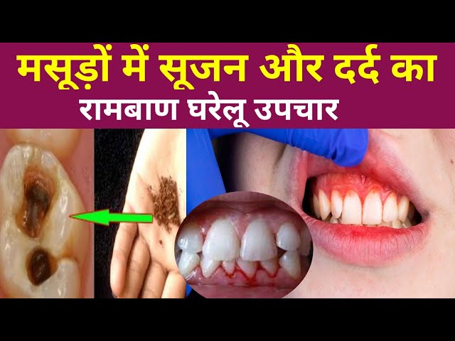 मसूड़ों में Infection, दर्द और सूजन का घरेलू इलाज|| masudon ki sabhi problem ka gharelu ilaj||