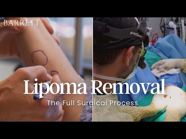 Lipoma Removal Surgery: Everything You Need to Know