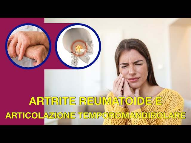 Artrite reumatoide e articolazione temporomandibolare