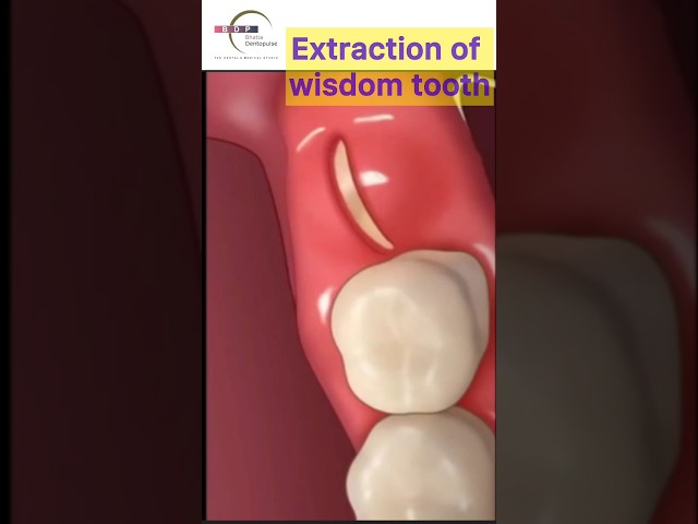 How is Wisdom Tooth Removed by surgery?