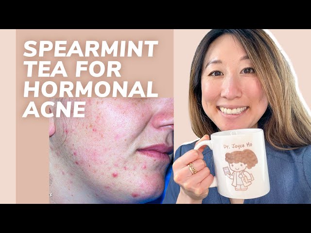 SPEARMINT TEA FOR ACNE? Dermatologist Explains