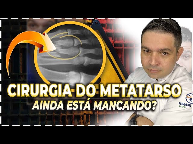 FRATURA DO METATARSO E AINDA MANCANDO