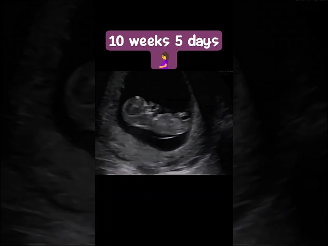 Ultrasound showing baby at 10 weeks 5 days #baby #pregnancy #mother #shorts