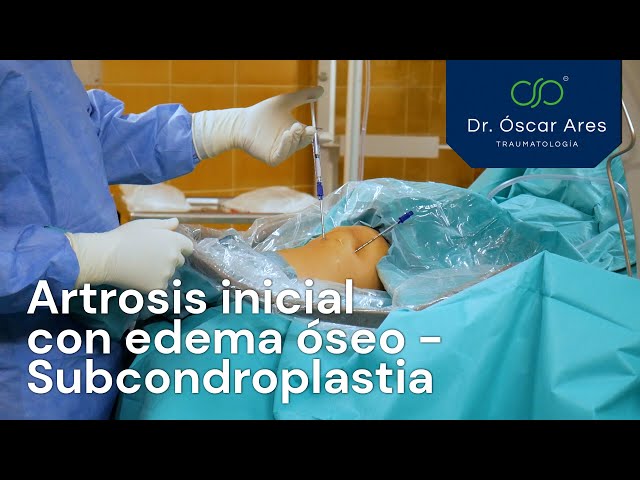 Artrosis inicial con edema óseo - Tratamiento con subcondroplastia - Dr. Oscar Ares