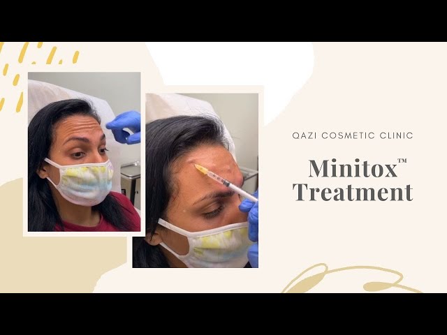 Signature Minitox™ Injections | Live with Dr. Nadir Qazi