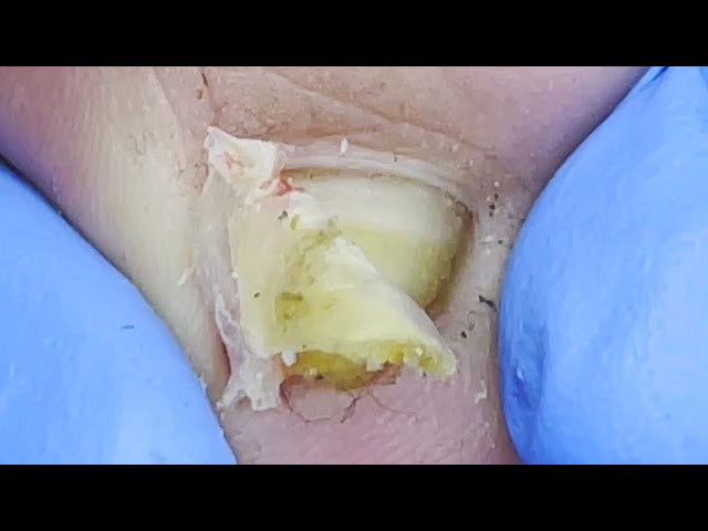 Super decompression! Deep ingrown nails that dig deep pits