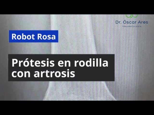 Robot Rosa. Prótesis en rodilla con artrosis - Dr. Oscar Ares