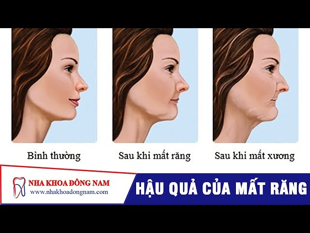 Hậu Quả Của Việc Bị Mất Răng | NHA KHOA ĐÔNG NAM®