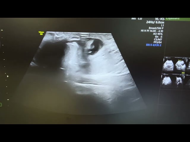 Ultrasound of strangulated umbilical hernia showing omental herniation with fluid.