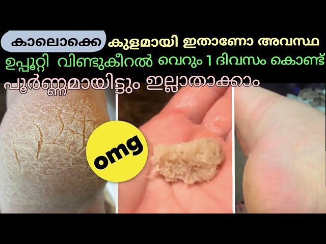 😱ഉപ്പൂറ്റി വിണ്ടുകീറൽ വീട്ടിൽ തന്നെ പരിഹാരം|Home rRemedy for Cracked HeelMalayalam #viralvideo