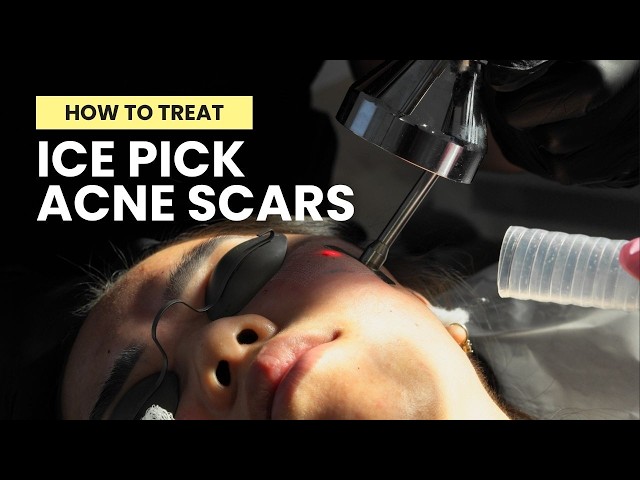 Dr Qazi : How to Treat Ice Pick Acne Scars: TCA Cross, Subcision, CO2 Laser, Erbium Laser