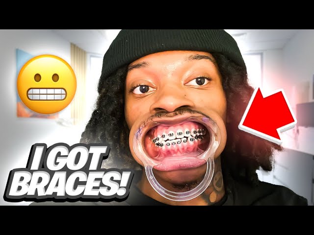 GETTING BRACES FOR THE FIRST TIME…